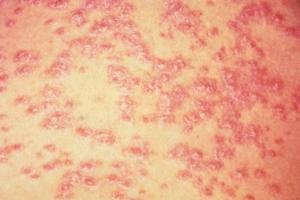 Psoriasis y dermatitis